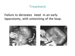 Treatment
Failure to derotates need in an early
laparotomy, with untwisting of the loop.
 