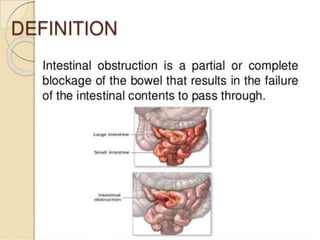 intestinal obstruction. B.Sc Nursing 2 year digestive system | PPTX