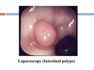 Laparoscopy (Intestinal polyps)   
