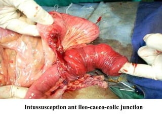 Intussusception ant ileo-caeco-colic junction 