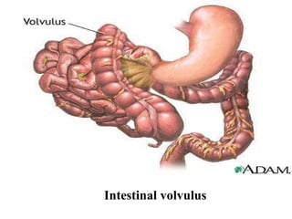 Intestinal volvulus 