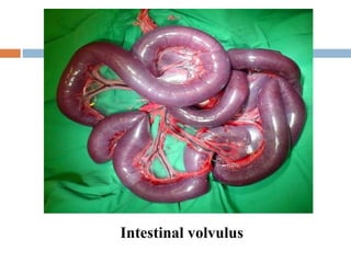Intestinal volvulus 