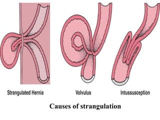 Causes of strangulation 