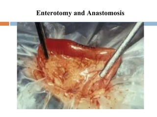 Enterotomy and Anastomosis 