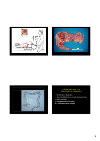 Intestinal obstruction | PDF
