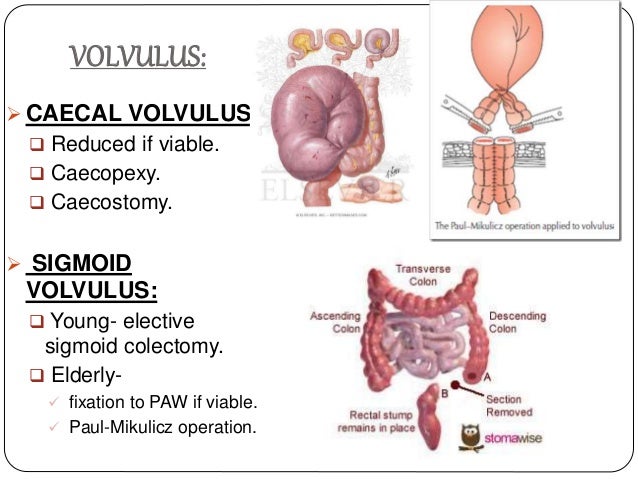 pathophysiology of bowel obstruction pdf