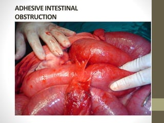ADHESIVE INTESTINAL
OBSTRUCTION
 