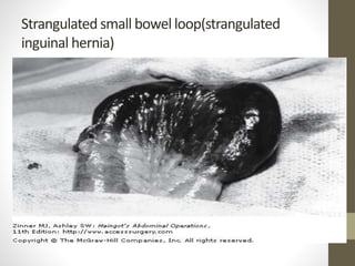 Strangulated small bowel loop(strangulated
inguinal hernia)
 