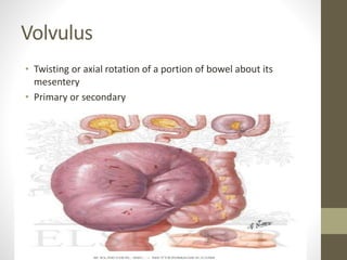 Volvulus
• Twisting or axial rotation of a portion of bowel about its
mesentery
• Primary or secondary
 