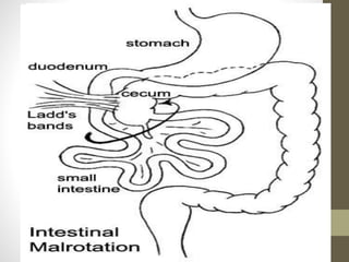 Malrotation & neonatal volvulus
• Treatment:
• The volvulus is reduced, the
transduodenal band(Ladd’s band)
divided, the duodenum mobilised & the
mesentry freed.
• Appendicectomy is routinely performed
to avoid diagnostic difficulty with
appendicitis in the future.
• Infarcted bowel necessitates resection.
 