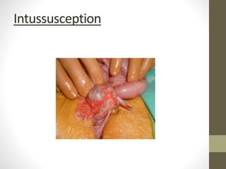 Intussusception
 