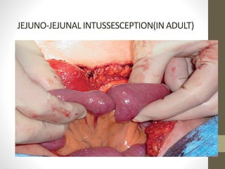 JEJUNO-JEJUNAL INTUSSESCEPTION(IN ADULT)
 