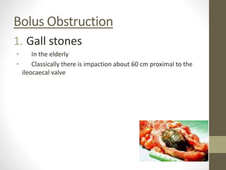 Bolus Obstruction
1. Gall stones
• In the elderly
• Classically there is impaction about 60 cm proximal to the
ileocaecal valve
 