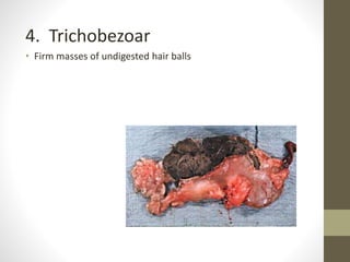 4. Trichobezoar
• Firm masses of undigested hair balls
 