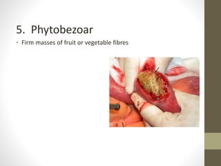 5. Phytobezoar
• Firm masses of fruit or vegetable fibres
 