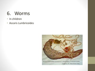 6. Worms
• In children
• Ascaris Lumbricoides
 
