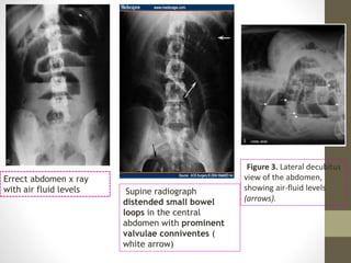 Errect abdomen x ray
with air fluid levels Supine radiograph
distended small bowel
loops in the central
abdomen with prominent
valvulae conniventes (
white arrow)
Figure 3. Lateral decubitus
view of the abdomen,
showing air-fluid levels
(arrows).
 