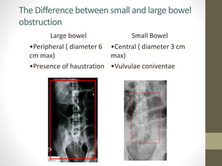 The Difference between small and large bowel
obstruction
Small BowelLarge bowel
•Central ( diameter 3 cm
max)
•Vulvulae coniventae
•Peripheral ( diameter 6
cm max)
•Presence of haustration
 