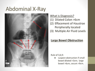 Abdominal X-Ray
What is Diagnosis?
(1) Dilated Colon >6cm
(2) Effacement of Haustrae
Peripherally located
(3) Multiple Air Fluid Levels
Large Bowel Obstruction
Rule of 3,6,9:
 suspect obstruction if small
bowel dilated >3cm; large
bowel >6cm, cecum >9cm.
 