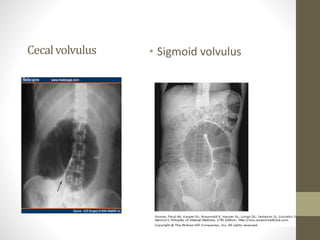 Cecalvolvulus • Sigmoid volvulus
 