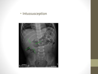 • Intussusception
 
