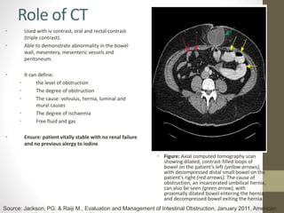 Role of CT
• Used with iv contrast, oral and rectal contrast
(triple contrast).
• Able to demonstrate abnormality in the bowel
wall, mesentery, mesenteric vessels and
peritoneum.
• It can define:
• the level of obstruction
• The degree of obstruction
• The cause: volvulus, hernia, luminal and
mural causes
• The degree of ischaemia
• Free fluid and gas
• Ensure: patient vitally stable with no renal failure
and no previous alergy to iodine
• Figure: Axial computed tomography scan
showing dilated, contrast-filled loops of
bowel on the patient’s left (yellow arrows),
with decompressed distal small bowel on the
patient’s right (red arrows). The cause of
obstruction, an incarcerated umbilical hernia,
can also be seen (green arrow), with
proximally dilated bowel entering the hernia
and decompressed bowel exiting the hernia.
Source: Jackson, PG. & Raiji M., Evaluation and Management of Intestinal Obstruction, January 2011, American
 