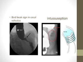 intussuseption• Bird beak sign in cecal
volvulus
 