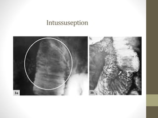 Intussuseption
 