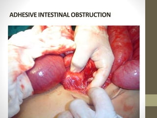 ADHESIVE INTESTINAL OBSTRUCTION
 