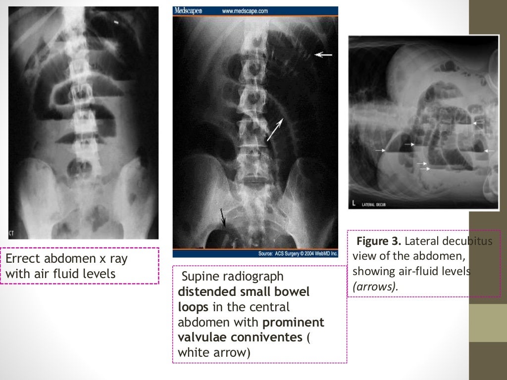 Intestinal Obstruction By Dr Usman Haqqani