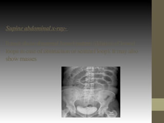 Supine abdominal x-ray-
It may show abnormal bowel pattern (dilation of bowel
loops in case of obstruction or sentinel loop). It may also
show masses
 