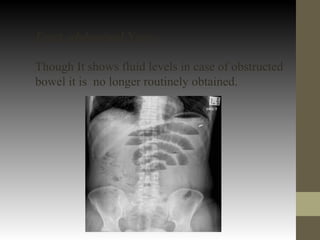 Erect abdominal Xray-
Though It shows fluid levels in case of obstructed
bowel it is no longer routinely obtained.
 
