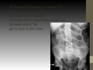 Radiological features of obstruction
■ The obstructed small bowel is
characterized by straight
segments that are generally central and
lie transversely. No
gas is seen in the colon
 