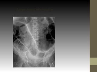 Large bowel obstruction
 
