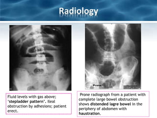Radiology
Fluid levels with gas above;
‘stepladder pattern’. Ileal
obstruction by adhesions; patient
erect.
Prone radiograph from a patient with
complete large bowel obstruction
shows distended lagre bowel in the
periphery of abdomen with
haustration.
 