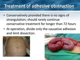 Treatment of adhesive obstruction
• Conservatively provided there is no signs of
strangulation; should rarely continue
conservative treatment for longer than 72 hours
• At operation, divide only the causative adhesion
and limit dissection.
 
