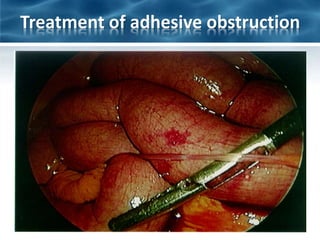 Treatment of adhesive obstruction
 
