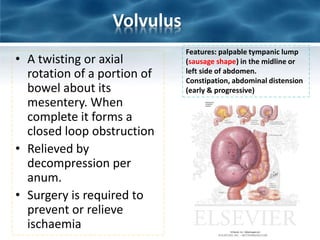 Volvulus
• A twisting or axial
rotation of a portion of
bowel about its
mesentery. When
complete it forms a
closed loop obstruction
• Relieved by
decompression per
anum.
• Surgery is required to
prevent or relieve
ischaemia
Features: palpable tympanic lump
(sausage shape) in the midline or
left side of abdomen.
Constipation, abdominal distension
(early & progressive)
 