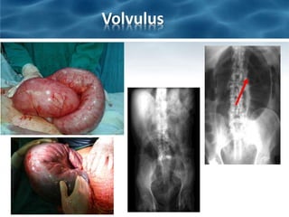 Volvulus
 