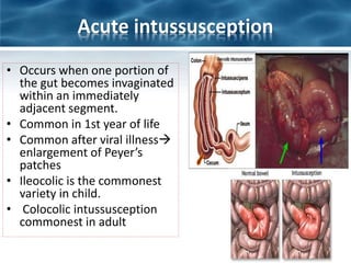 Acute intussusception
• Occurs when one portion of
the gut becomes invaginated
within an immediately
adjacent segment.
• Common in 1st year of life
• Common after viral illness
enlargement of Peyer’s
patches
• Ileocolic is the commonest
variety in child.
• Colocolic intussusception
commonest in adult
 