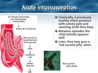 Classically, a previously
healthy infant presents
with colicky pain and
vomiting (milk then bile).
Between episodes the
child initially appears
well.
Later, they may pass a
‘red currant jelly’ stool.
Red currant
jelly stools
Acute intussusception
 