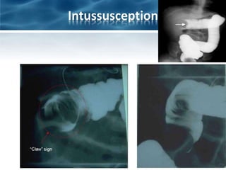 Intussusception
 