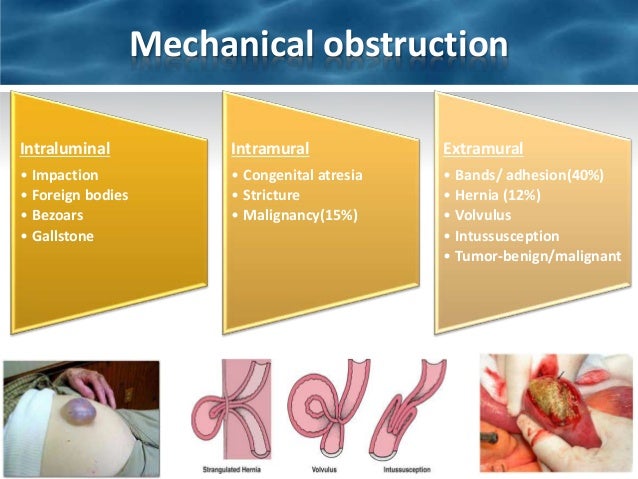Intestinal obstruction