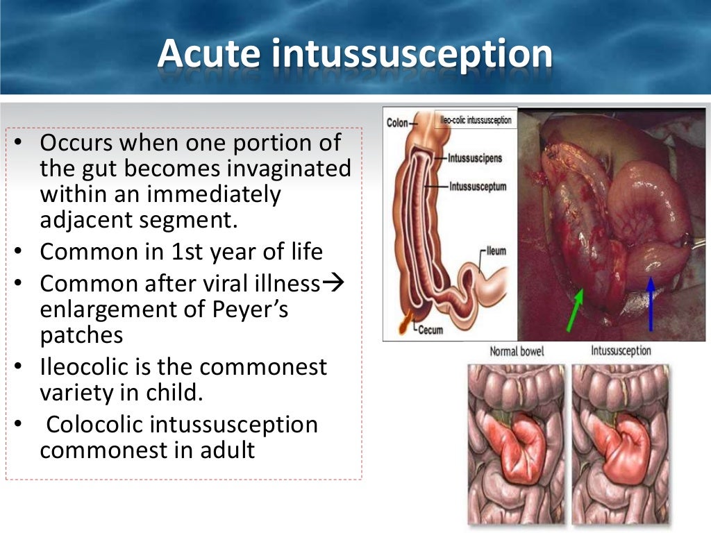 Intestinal obstruction