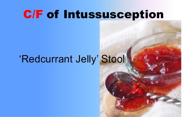 Red Currant Jelly Intussusception Stool Pictures