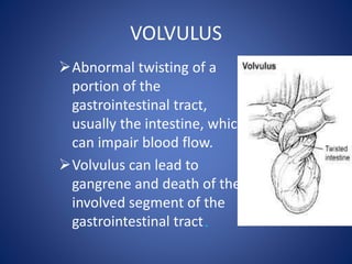 VOLVULUS
Abnormal twisting of a
portion of the
gastrointestinal tract,
usually the intestine, which
can impair blood flow.
Volvulus can lead to
gangrene and death of the
involved segment of the
gastrointestinal tract.
 