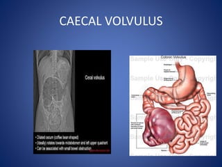 CAECAL VOLVULUS
 