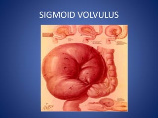 SIGMOID VOLVULUS
 