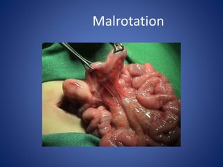 Malrotation
 