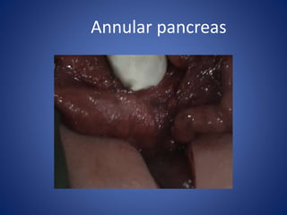 Annular pancreas
 